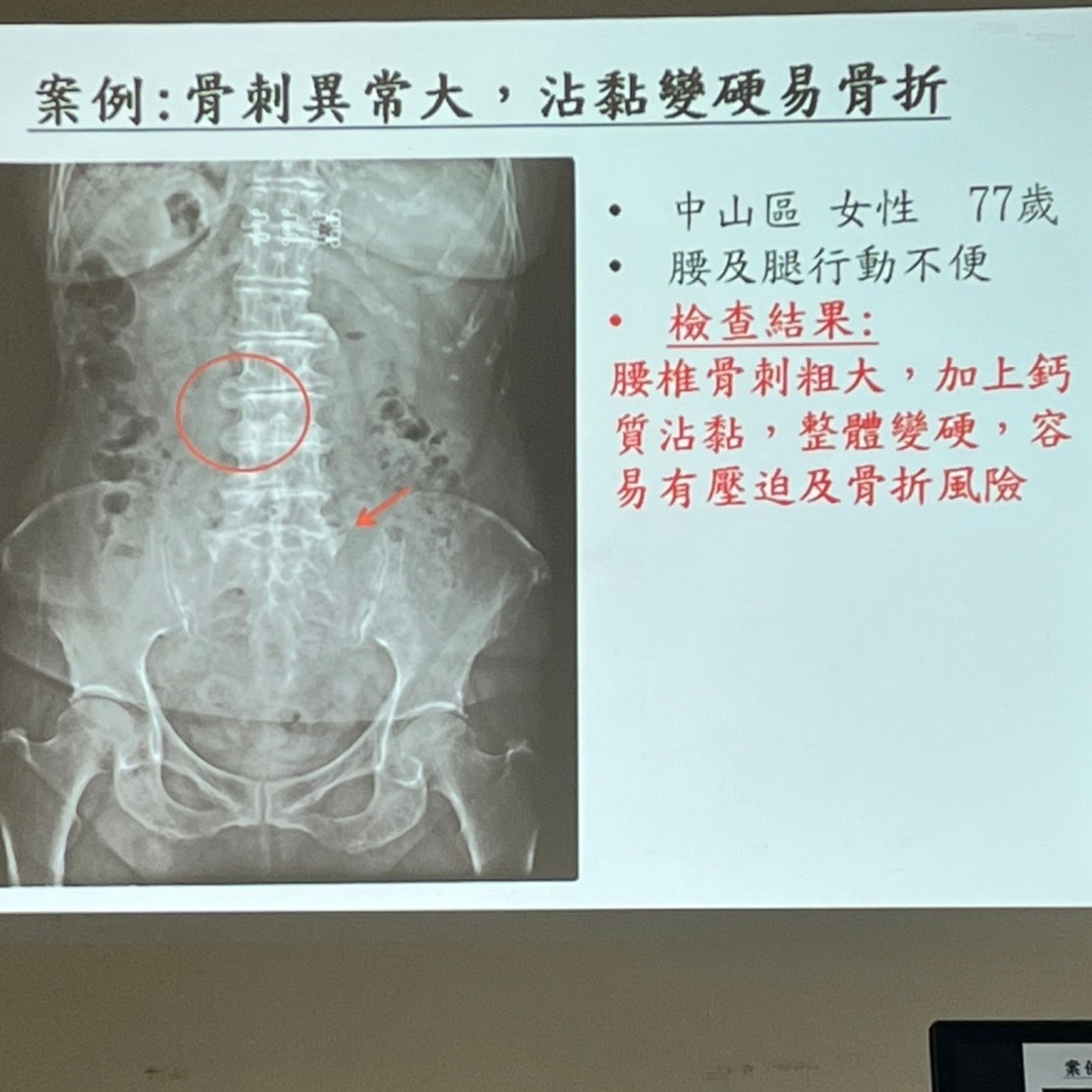 113年9月-健骨防鬆新觀念